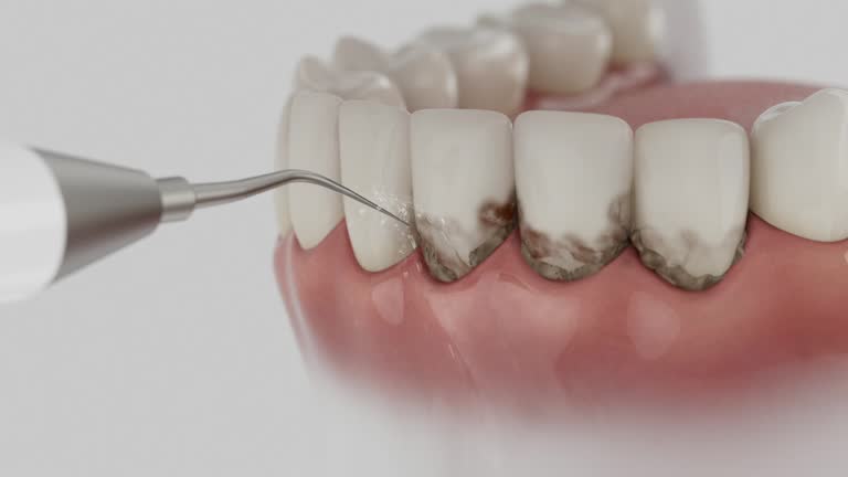 Trusted Wisdom Tooth Removal service in LaBarque Creek, MO - Dentist Open Now